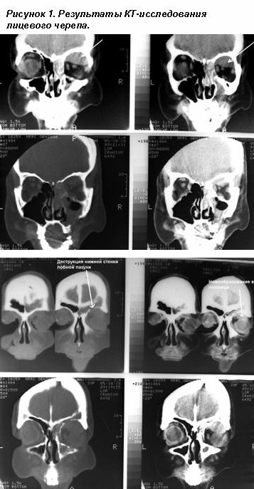 Компьютерная томография лицевого черепа